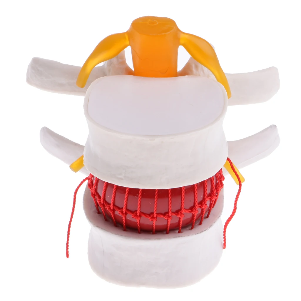  Anatomical Human Lumbar Vertebrae Degenerative Disc Model  Lab Demonstration Supplies  Medical Teac - 33036948097