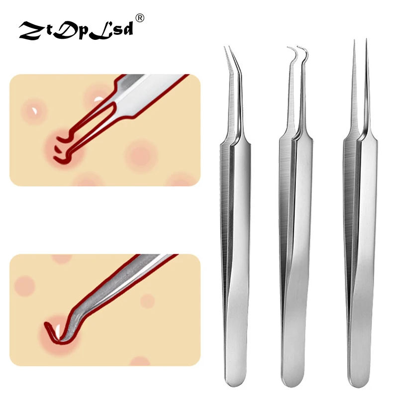ZtDpLsd 1 шт. Профессиональный из нержавеющей стали для удаления черных точек, прыщей, прыщей, пятен, экстрактор, зажим, игла, пинцет, инструменты