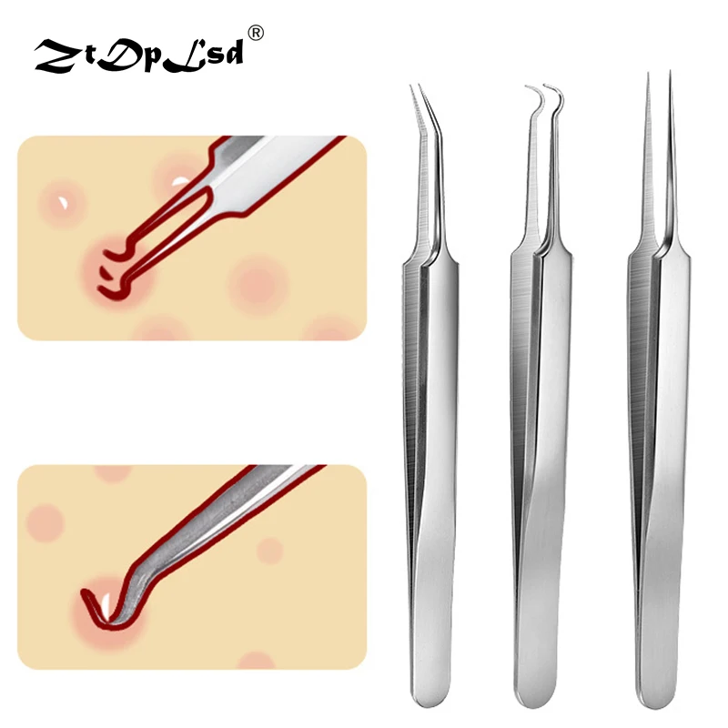 

ZtDpLsd 1Pcs Professional Stainless Steel Blackhead Acne Pimple Blemish Extractor Remover Clip Needle Tweezers Tools