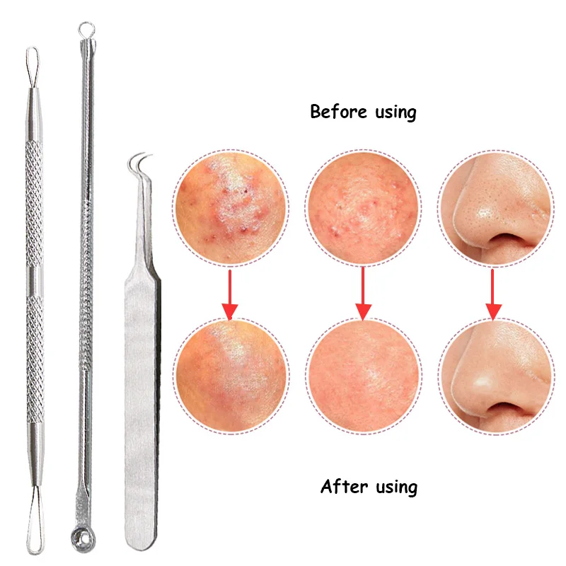 

Vopregezi 3Pcs/Set Blackhead Tweezers Face Cleaning Black Spots Removal Face Care Tools Acne Pimple Extractor Black Head Remover