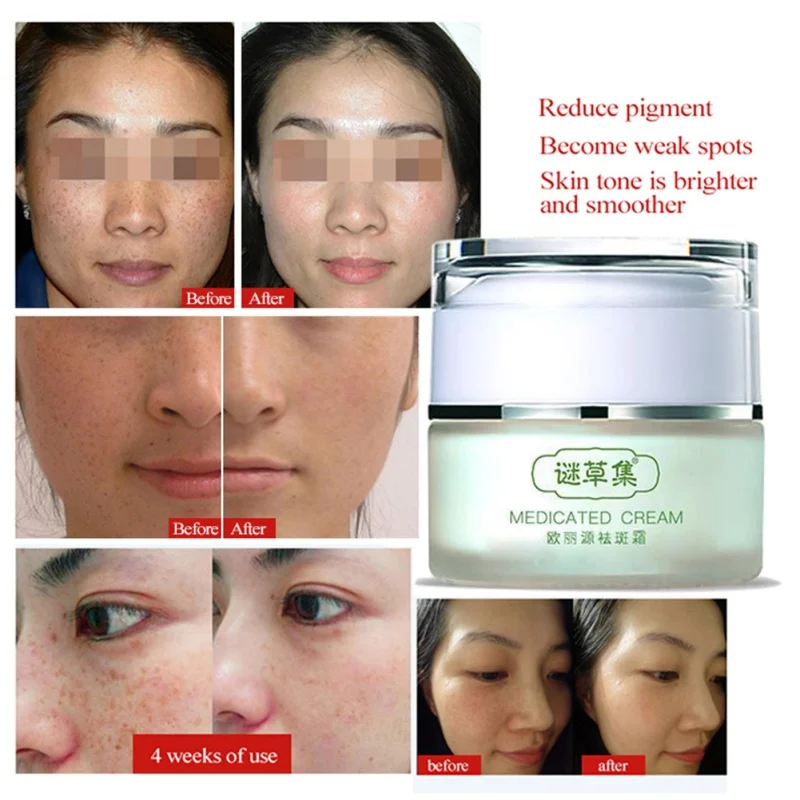 

Strong Effects Powerful Whitening Freckle Cream 25g Remove Melasma Acne Spots Pigment Melanin Dark Spots Face Care Cream