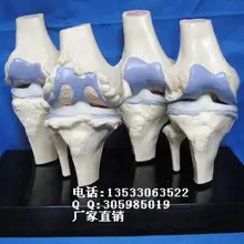 Нормальный колено модели и патологических изменений колена сравнить Скелет Спецодежда медицинская человека образцы