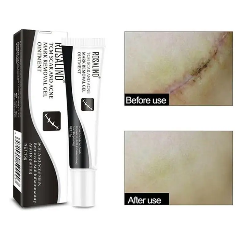 

Acne Scar Removal Face Pigmentation Corrector Cream Removing Anti-inflammatory Spots Repairing Skin Ointment Oil Control Cream
