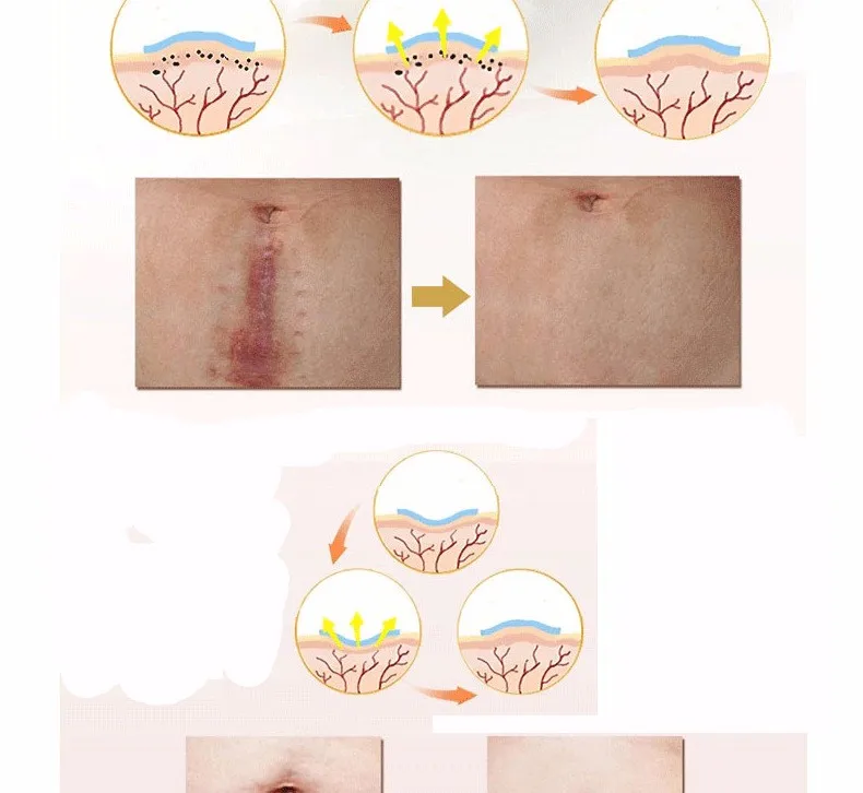 3,5*12 см 1 шт органический силиконовый гель шрам терапия патч быть мыть и повторно использовать