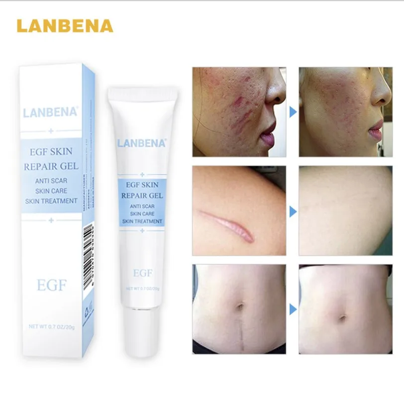 lanbena stretch mark removal