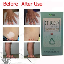 35ml Professional White Spot Antibacterial Liquid Chinese Medicine Care Solution Skin Vitiligo Treatment For Leukoplakia Disease