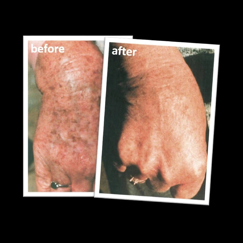 hand black spot removal cream