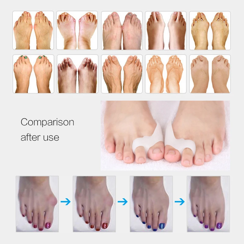 2Pcs Pedicure Concealer for Toes Gel Pedicure Stretchers Bunion Protector Straightener Bunion Corrector Foot Care Hallux Valgus