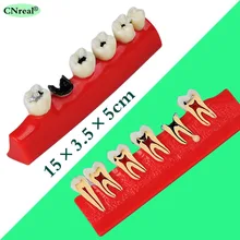 1 pc Dental Teeth Model for Caries Pathology Illustration Teaching and Dentist-patient Communication 1 pc Dental Teeth Model for Caries Pathology Illustration Teaching and Dentist-patient Communication