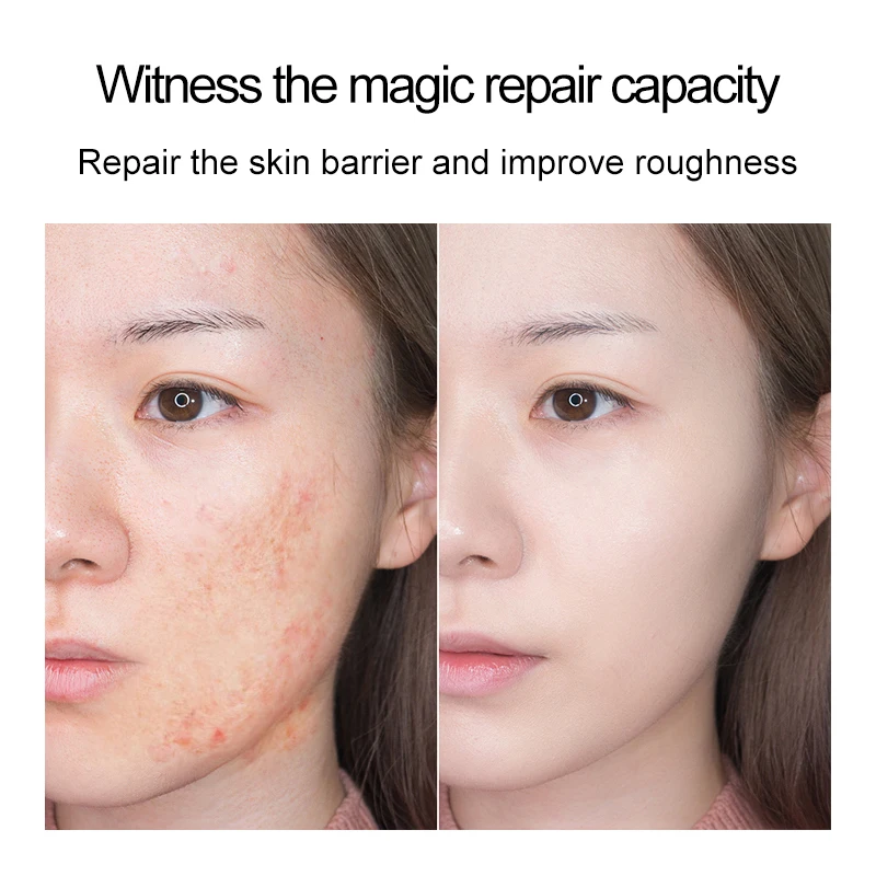 Oligopeptide Capsule 30 Piece Repair Acne Pit Acne Scar Marks Pigmentation Corrector Essential Oil Soothing Squalane Essence