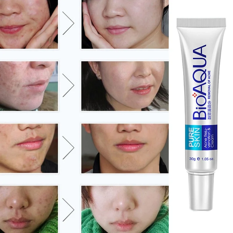

Acne Cleaning Cream Skin Care Remove Repair Comedone Pimple Acne Quickly Face Acne Cream Remover Anti Acne Treatment