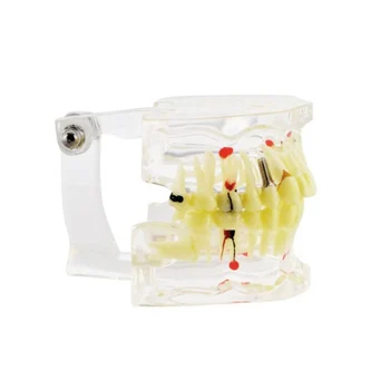 

Dental Study Teeth Model Transparent Adult Pathological Disease Tooth Dentistry