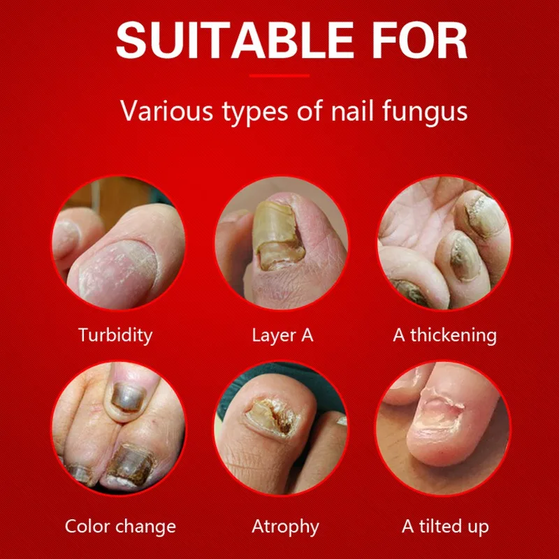 Уход за ногтями Лечение грибка масло онихомикоз Paronychia противогрибковые инфекция ногтей 15 г ремонт ногтей