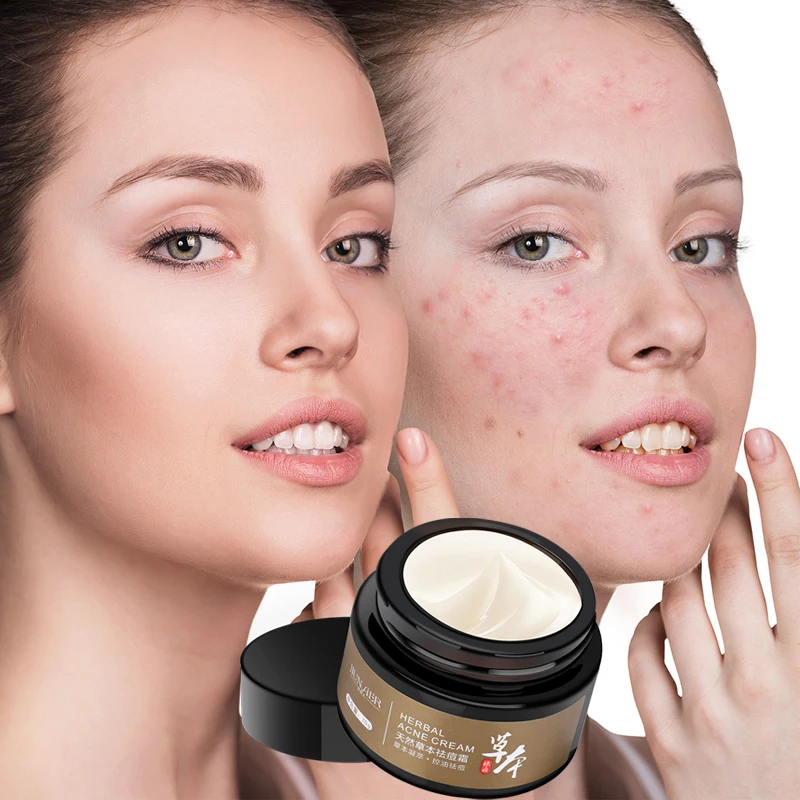Skin Care Herbal Acne Cream Pock to Acne Treatment Products Whitening