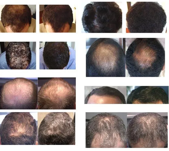 hair-regrowth effects