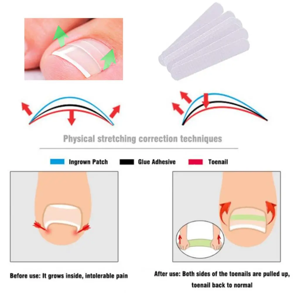 10 шт./кор. нейл-арта Запчасти коррекции Стикеры паронихии фиксаж восстановить ногти для ног "францзуский маникюр" эластичная заплатка корректор, ухаживает за кожей стоп педикюр инструменты