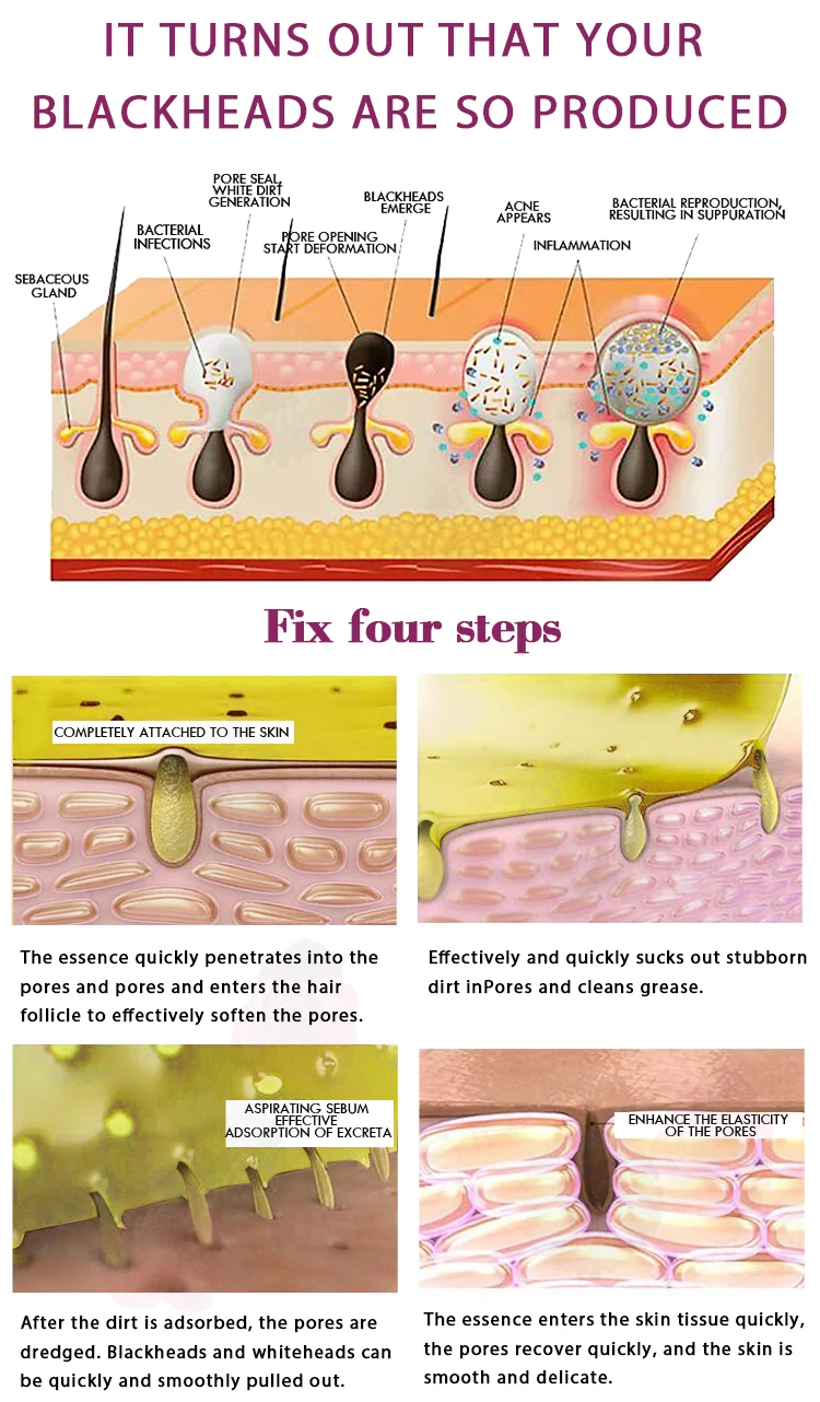 Средство для удаления черных точек, лечение угревой сыпи, контроль за маслами носа, маска для удаления пор, отбеливающая маска для очистки носа, уход за кожей, TSLM1