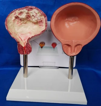 

Bladders Model Comparison Smoking Bladder Vs Normal Bladder Model Medical Science Teaching Model