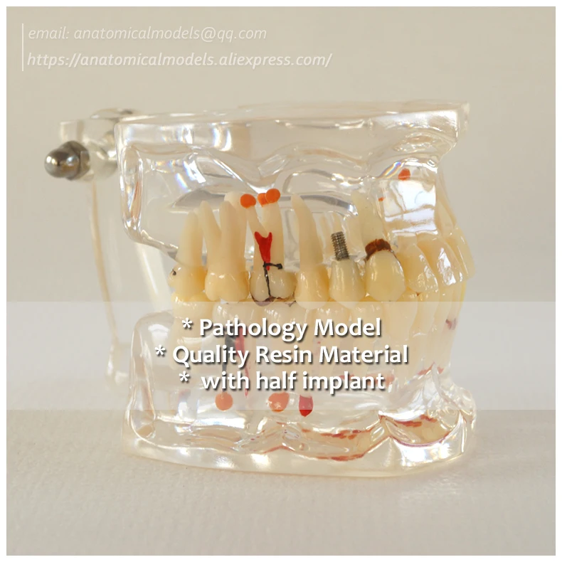 № 13056, зубная Патология модель с Половина имплантата, спецодежда медицинская научная образовательная обучение анатомические модели