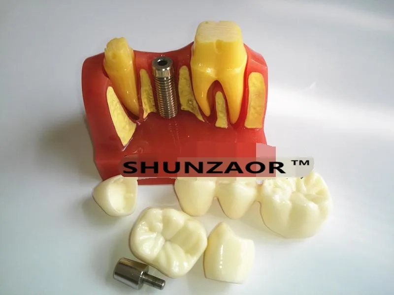 SHUNZAOR 4 раза зубные зубы модель имплантата для доктора-пациента демонстрация и фарфоровый мост восстановление