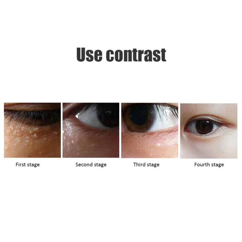 Жировые высыпания удаления крем для век морщины вокруг глаз сумка Гиалуроновая кислота глаз сущность для устранения темных кругов укрепляющий уход за кожей вокруг глаз