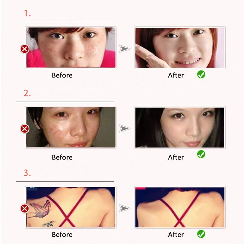 Laser Picosecond Pen Freckle Tattoo Removal Mole Dark Spot Eyebrow Pigment Laser Acne Treatment Machine Beauty Care 4