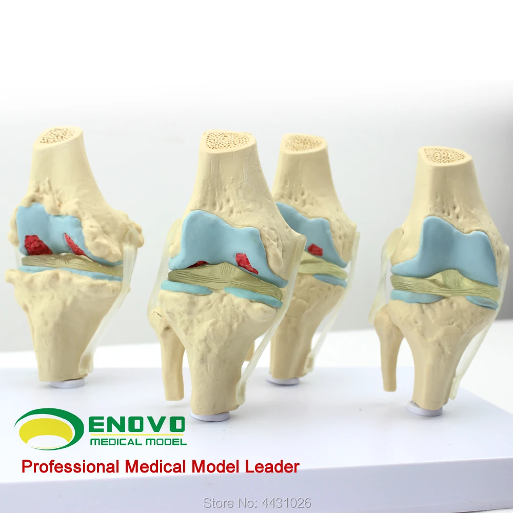 ENOVO человека патологических колена модель дегенеративных гемофилия ортопедические боли трубки bone модель