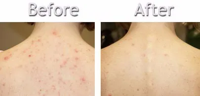 Back-Acne-5