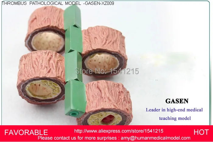 atherosclerosis-with-vascular-thrombosis-process-model-thrombosis-model