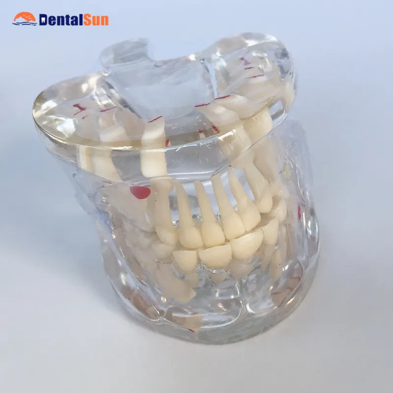 Стоматологический ортодонтический модель/прозрачные смешанные возраст модель ортодонтический, для зубов Модель HST-C5