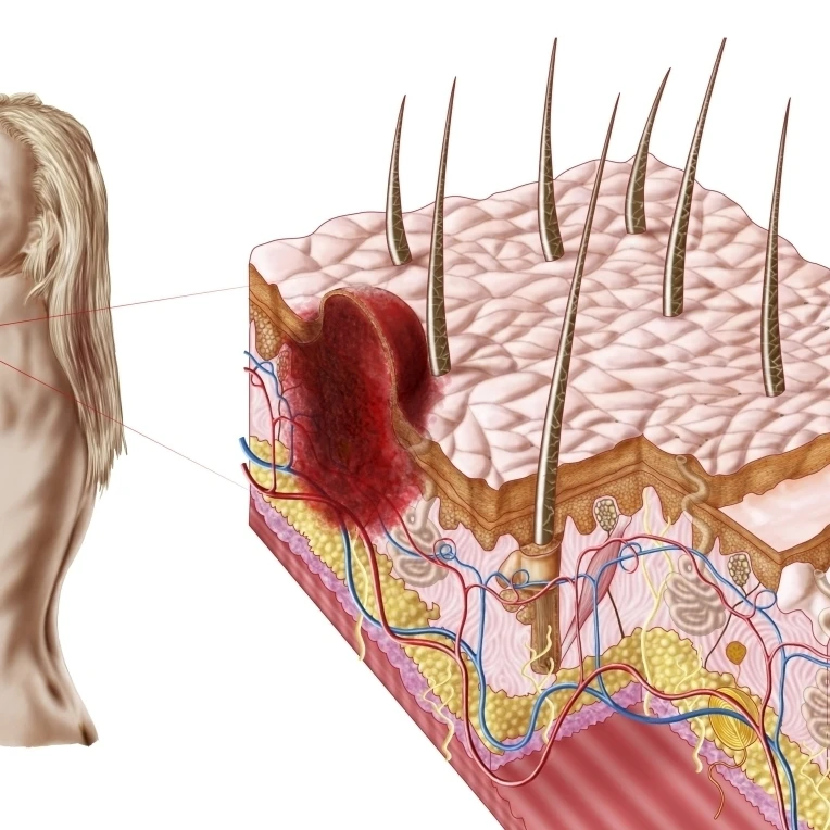 Illustration of an atypical growth on the skin that could be a sign of skin cancer Poster Print (16 x 12)