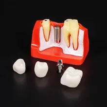 1pc 4 times planting solution model Detachable bridge crown for Demonstration planting repairing dental mold