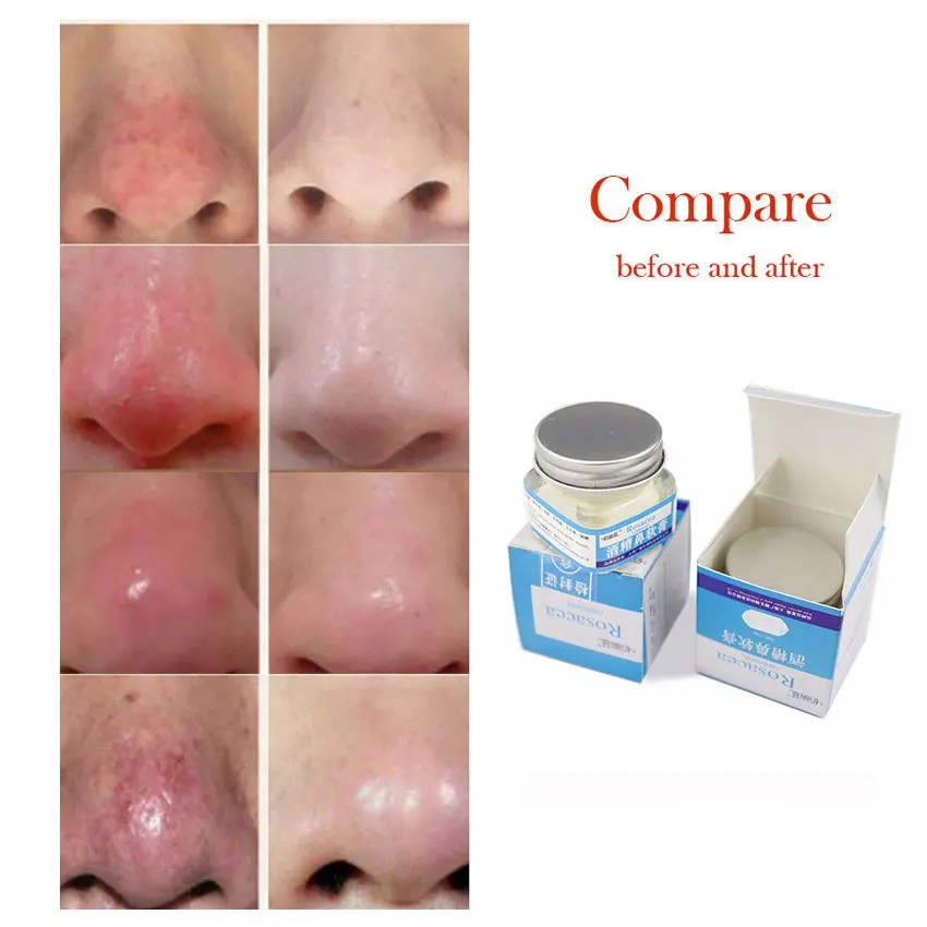 Anti Nose Mites Remove Acne Rosacea Cream Red Nose Blackhead Treatment