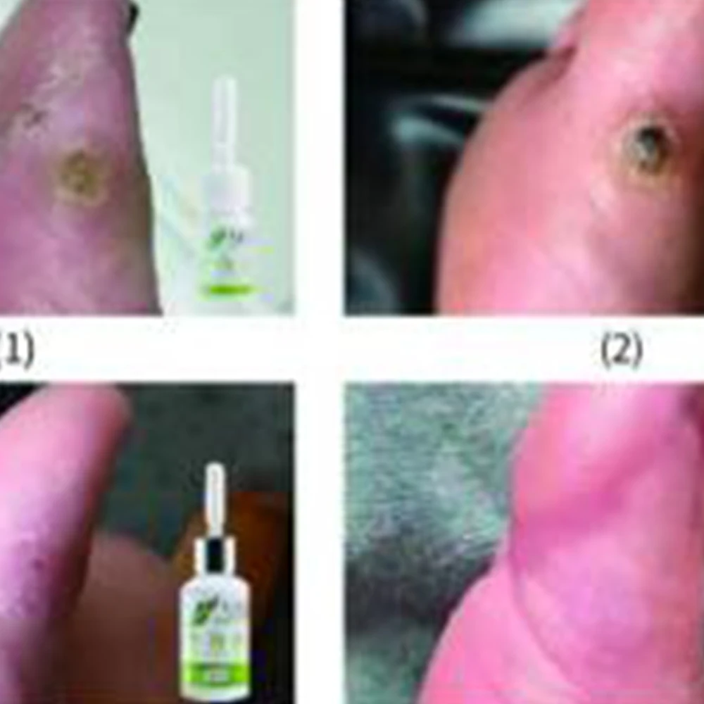 Средство для восстановления моль и кожи, безболезненное средство для восстановления моль, темное пятно, для лица, для бородавки, для ремонта веснушек, крем, масло, дропшиппинг D228