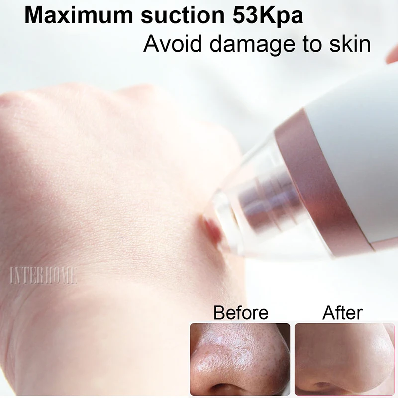 Blackhead-Remover-0899-2(6)
