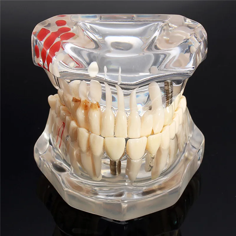 Стоматологический имплантат, модель зубов с реставрационным мостом, зубной Стоматолог для медицинской медицины, стоматологический инструмент для обучения болезни