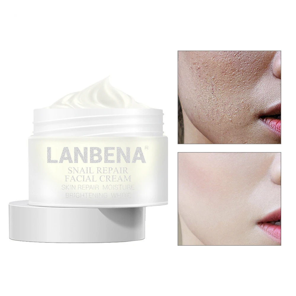 ordinary retinol acne