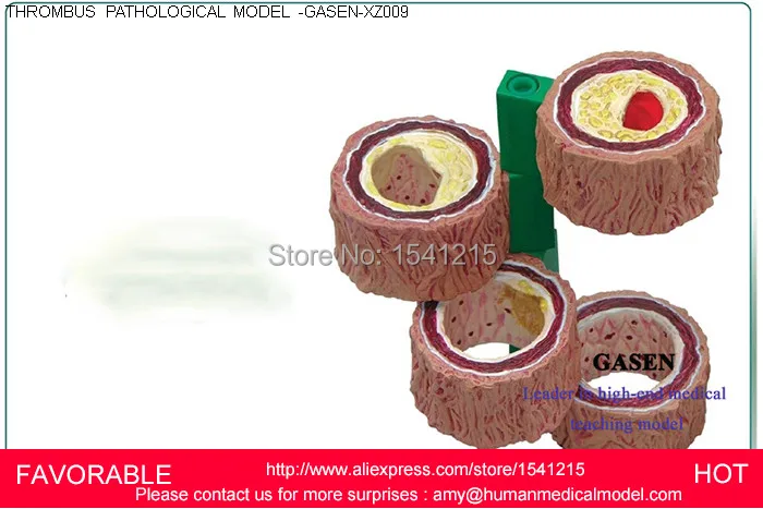 atherosclerosis-with-vascular-thrombosis-process-model-thrombosis-model