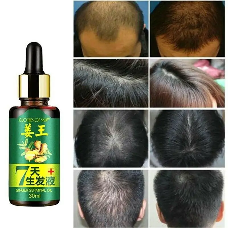 30ml regrad 7 días jengibre Germinal suero esencia aceite pérdida de cabello crecimiento de tratamiento - 1