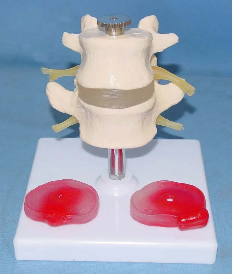 SHUNZAOR 2 поясничные позвонки с 3 повреждениями межпозвонковый диск демонстрационная модель человеческого скелета модель