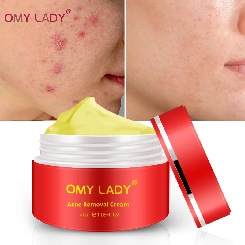 OMY LADY Strentch Marks акне крем для удаления шрамов лечение усадка пор гель отбеливания