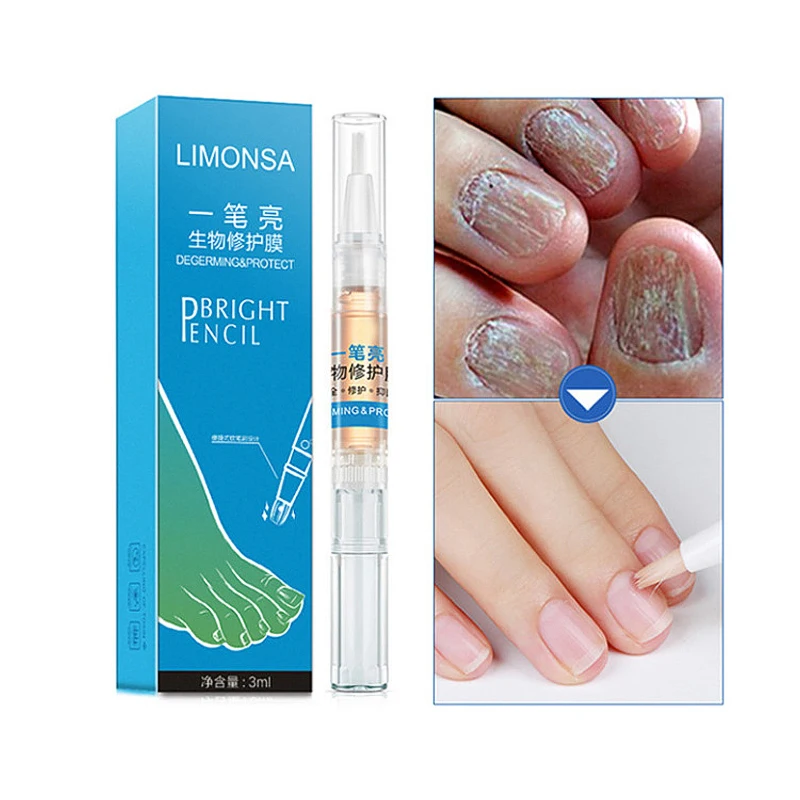 

3 Ml Onychomycosis Repair Pen Effective Paronychia Fungus Gel Fungal Nail Treatment Pen Fungal Nail Treatment Toenail Care TSLM1