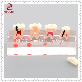 

Dentistry Deciduous Endodontic treatment tooth model/Dental Oral Endodontic treatment Demonstration teeth Model