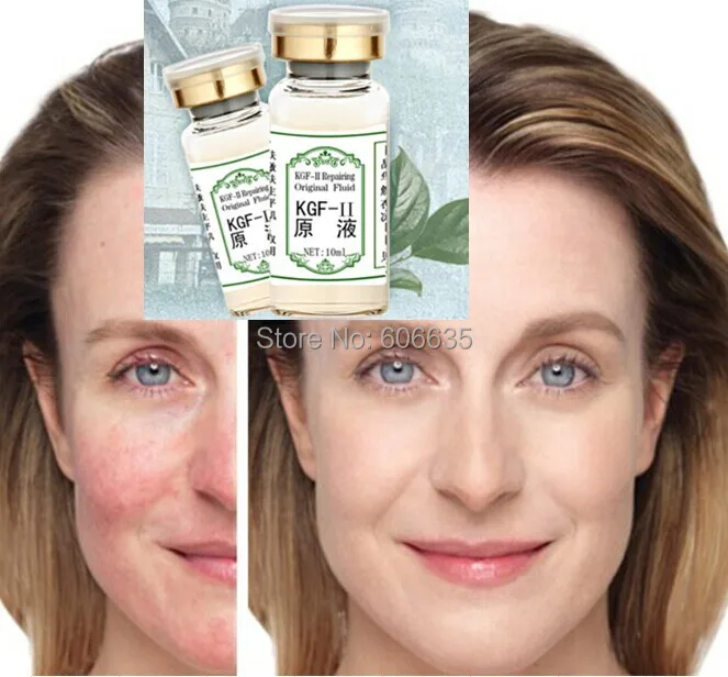 acne scars sensitive skin