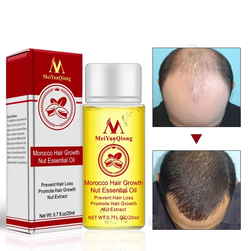 

20ml Hair Growth Products Ginger Oil Hair Growth Faster Grow Hair Ginger Shampoo Stop Hair Loss Treatment