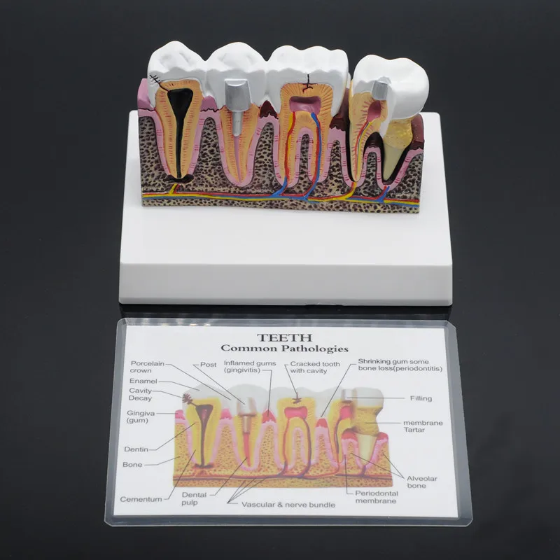 Демонстрация кариеса анатомические зубы общая модель патологий Стоматологическая, съемная