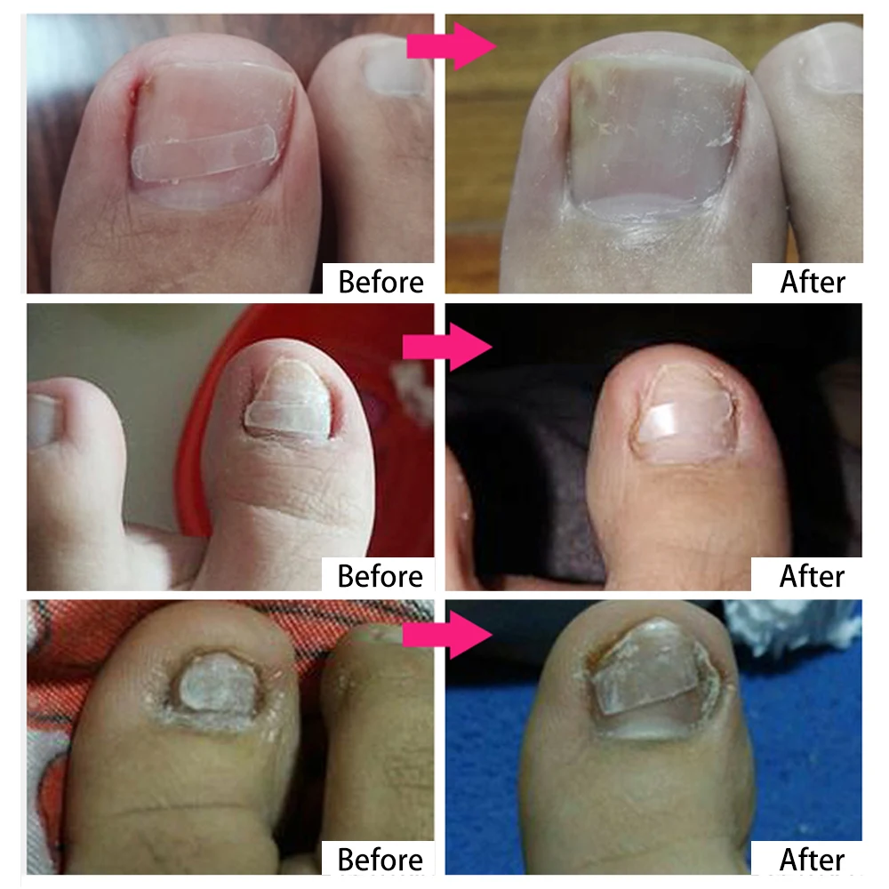 10 шт./кор. Ingrown Toe Коррекция ногтей стикер патч Paronychia коррекция файла эластичный патч корректор Уход за ногами Инструменты для лечения