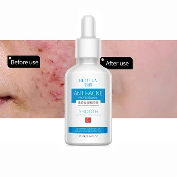 

30ml Beauty Face Skin Care Acne Remove Serum Pore Removal Moisturizer Facial Essence Anti-wrinkle