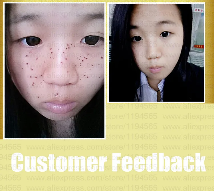 

2pcs Set Speckles Moles Warts Removal Black Spots Splashes Remover Free Shipping