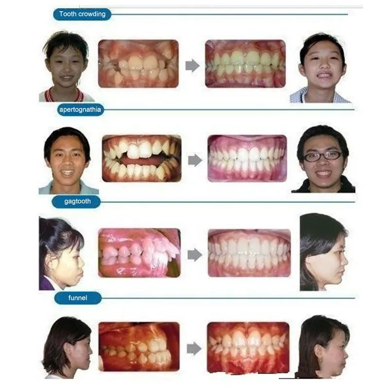 

Orthodontists Invisible Corrective Braces Upgraded Orthodontic Brackets All-shipping